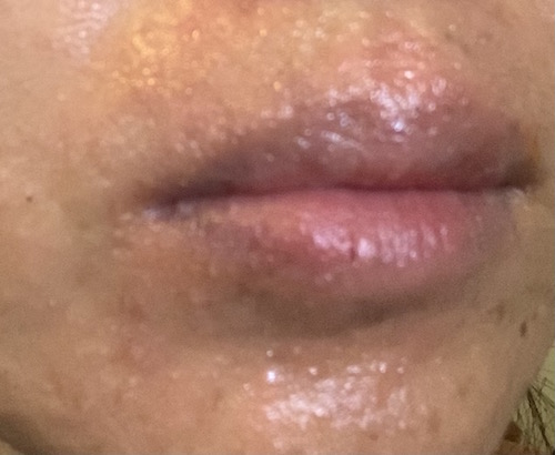 口囲皮膚炎：一週間のジュース断食（ファスティング）をした結果