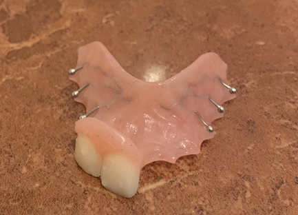 オーストラリアのインプラントと骨移植。部分入れ歯を作る
